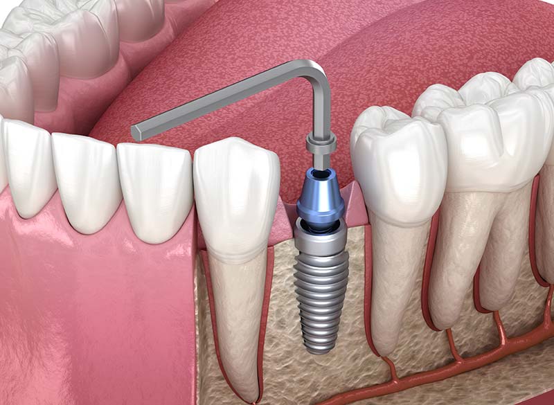 アバットメント（土台）の装着