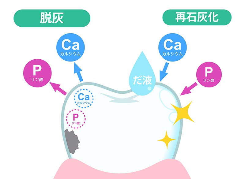 むし歯の原因